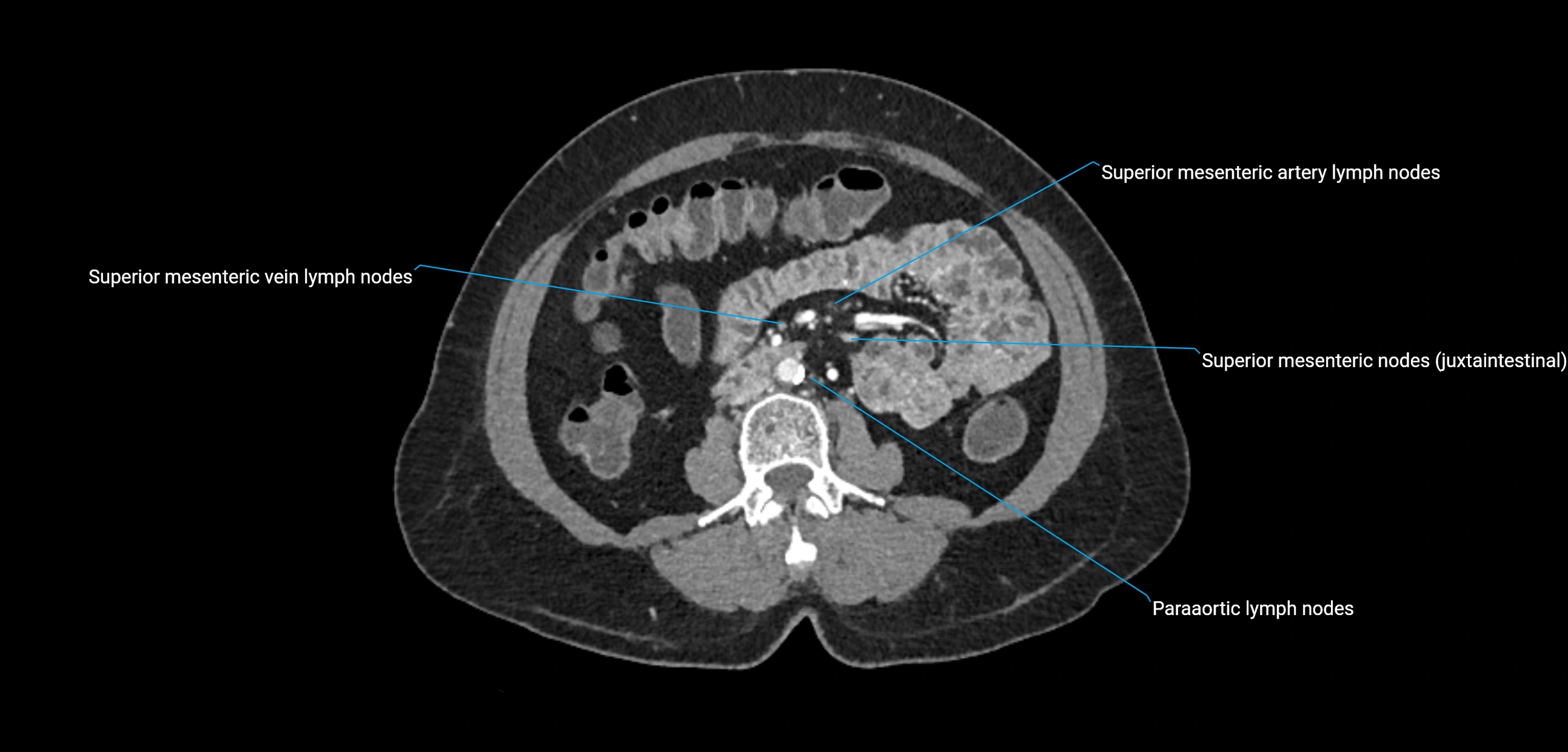 CT ct abdominal lymph nodes  axial cross sectional anatomy  enchanced radiology image -img-00002-00231.webp